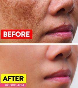 Clear Melasma Naturally With 8 Home Remedies Then You Will Remove Pigmentation From You Face