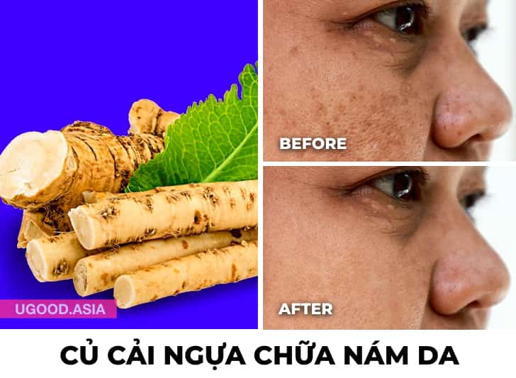 Trị Nám Da Tại Nhà Bằng 8 Nguyên Liệu Thiên Nhiên Này Và Bạn Sẽ Xoá Nám Da Mặt Hiệu Quả