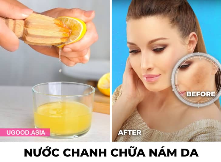 Trị Nám Da Tại Nhà Bằng 8 Nguyên Liệu Thiên Nhiên Này Và Bạn Sẽ Xoá Nám Da Mặt Hiệu Quả