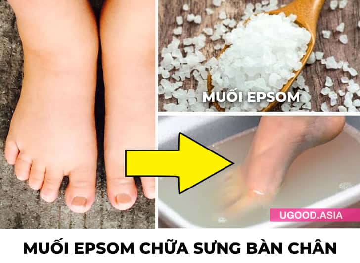 7 Cách Chữa Sưng Chân Phù Theo Cách Tự Nhiên Giúp Làm Giảm Sưng Tấy Ở Bàn Chân Và Mắt Cá Chân