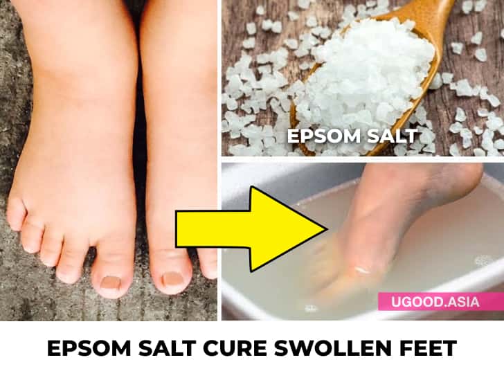 7 Home remedies for swollen feet That Natural Ways To Reduce Swelling In Your Feet and Ankle