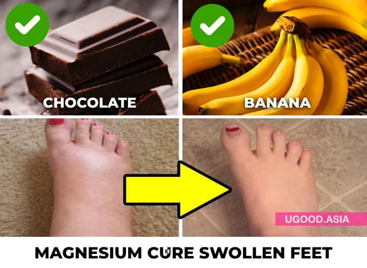 7 Home remedies for swollen feet That Natural Ways To Reduce Swelling In Your Feet and Ankle